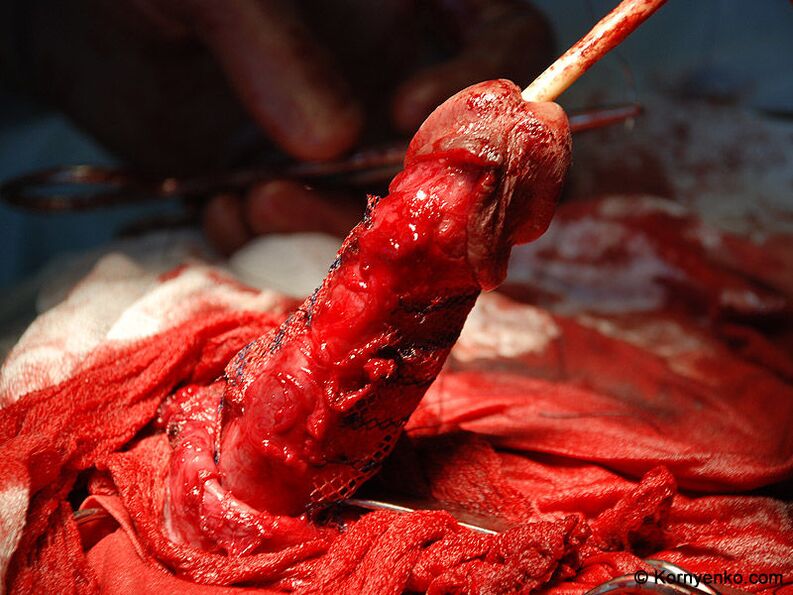 安装胶原蛋白基质以增大阴茎