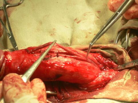 进行阴茎增大手术