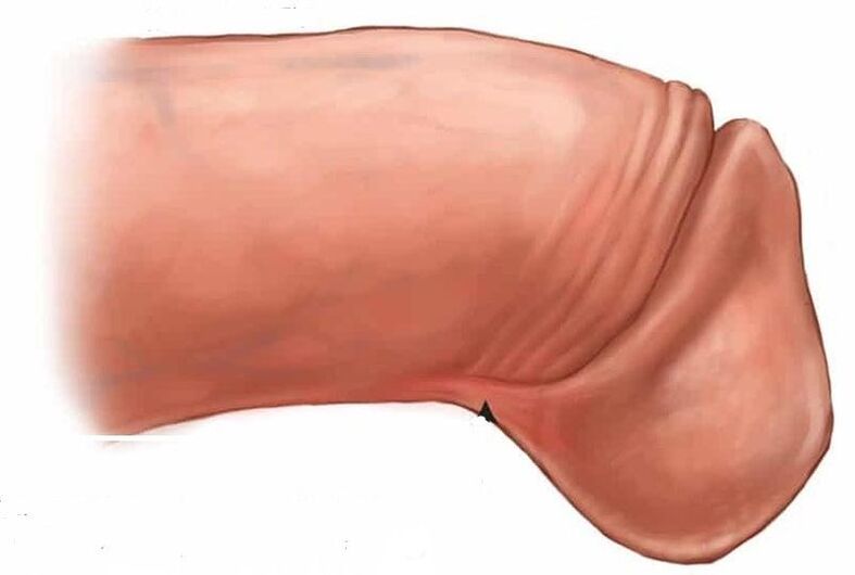 如何增大阴茎龟头